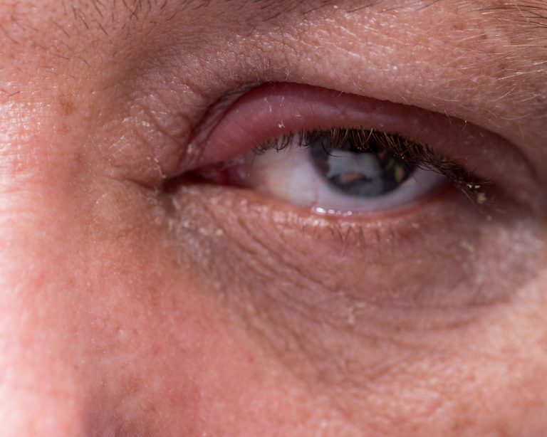 Blepharitis Causes Symptoms And Treatment Cataracteye