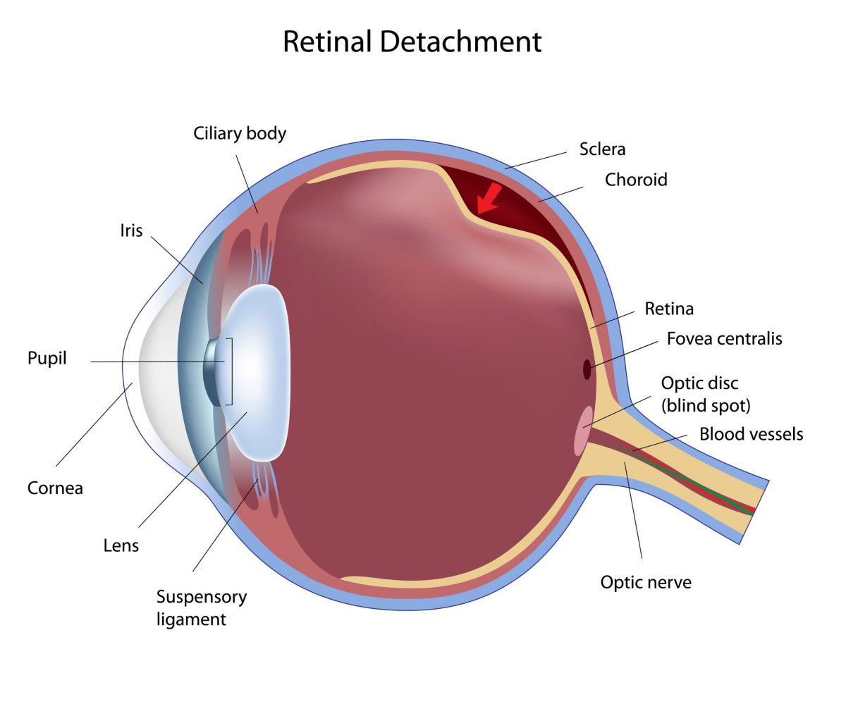 How Diabetes Cause Retinal Detachment